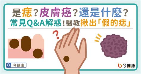 痣 凸起|是痣？還是皮膚癌？皮膚科醫師教你揪出「假的痣」，。